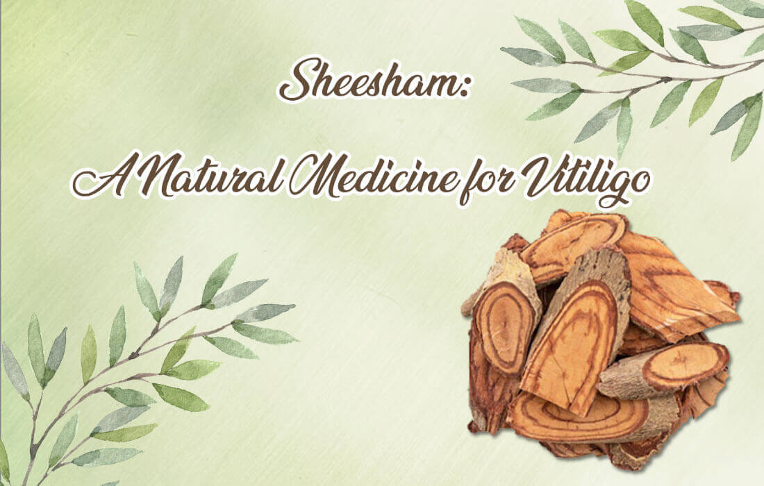 Sheesham: A Natural Medicine for Vitiligo